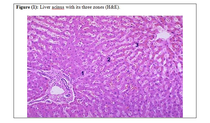 Stromal invasion and differential diagnosis between high grade dysplastic nodule and early hepatocellular carcinoma